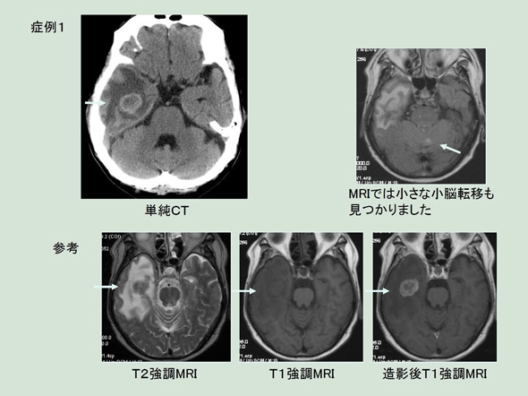 症例1 脳腫瘍 | 特定医療法人 同心会 遠山病院